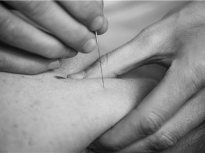 Dry Needling