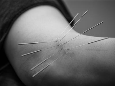 Dry Needling