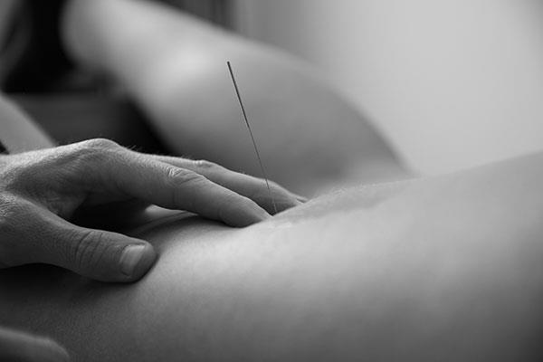 Dry Needling